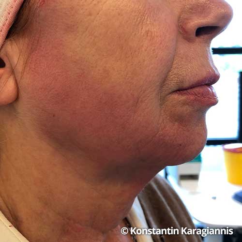Faden Lifting Ihre Hals Nasen Ohrenarztpraxis In Oldenburg Eversten